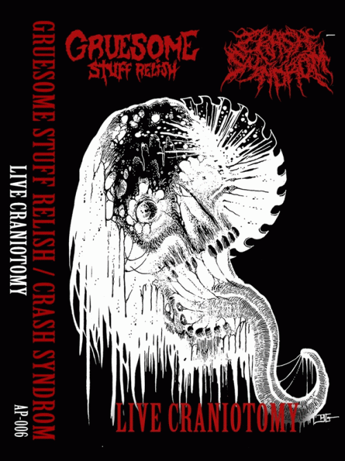 Crash Syndrom : Live Craniotomy